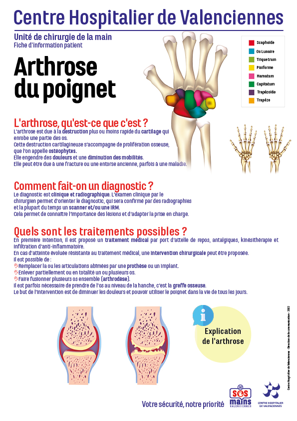 Arthrose du poignet 1